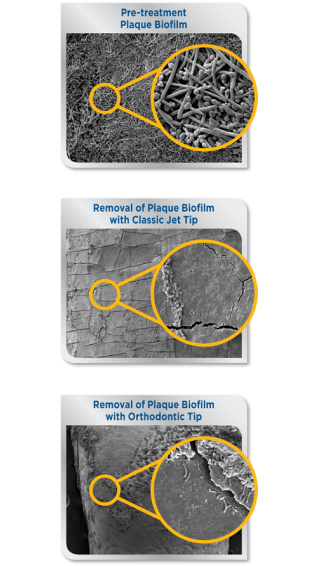 Waterpik® Water Flosser Removes 99.9% of Plaque Biofilm After 3-Second Treatment