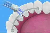 Water flosser tip cleaning inside of teeth with braces