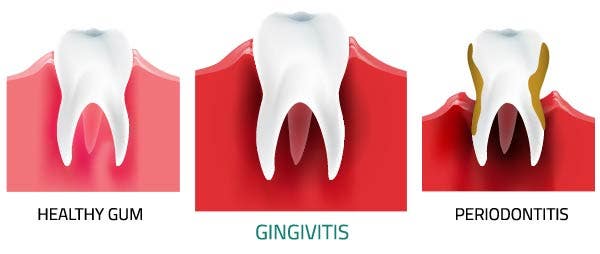 Healthy gum and gingivitis gum and periodontitis gum